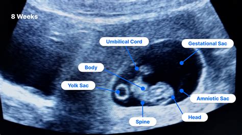 how accurate is dating ultrasound at 8 weeks